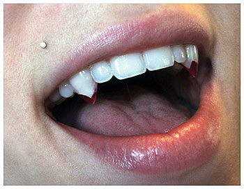 Small Blood Tip Vampire Fangs - Click Image to Close